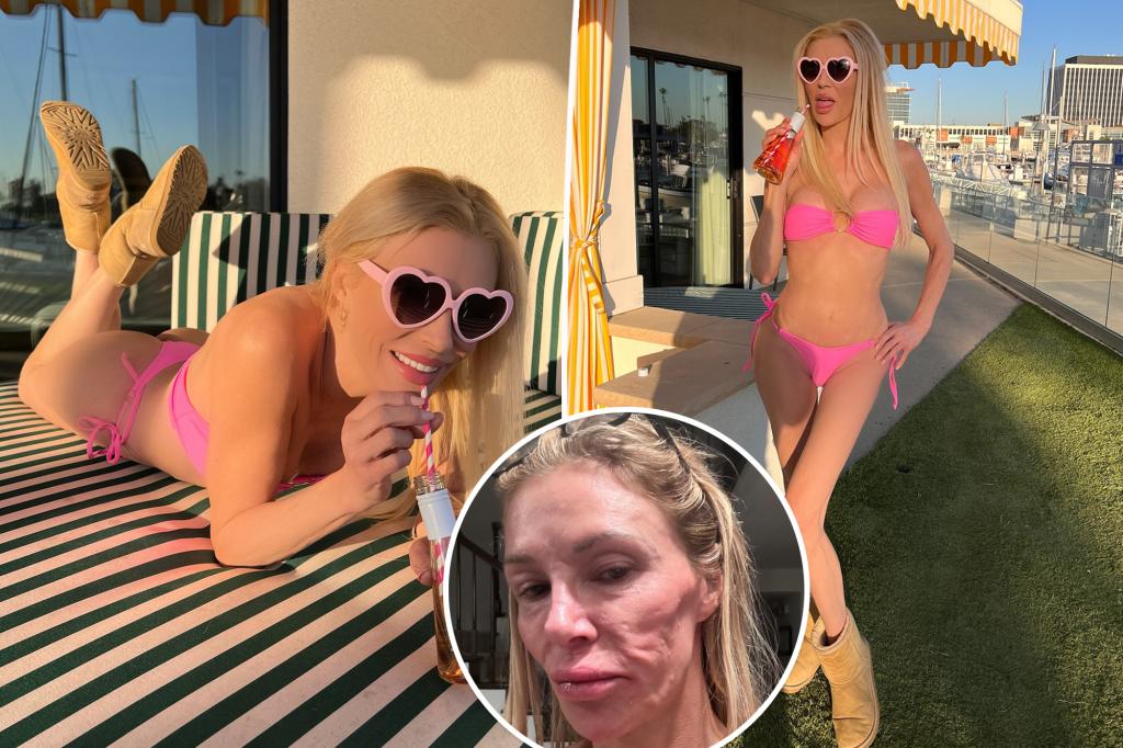 Brandi Glanville reveals off determine in bikini after facial parasite