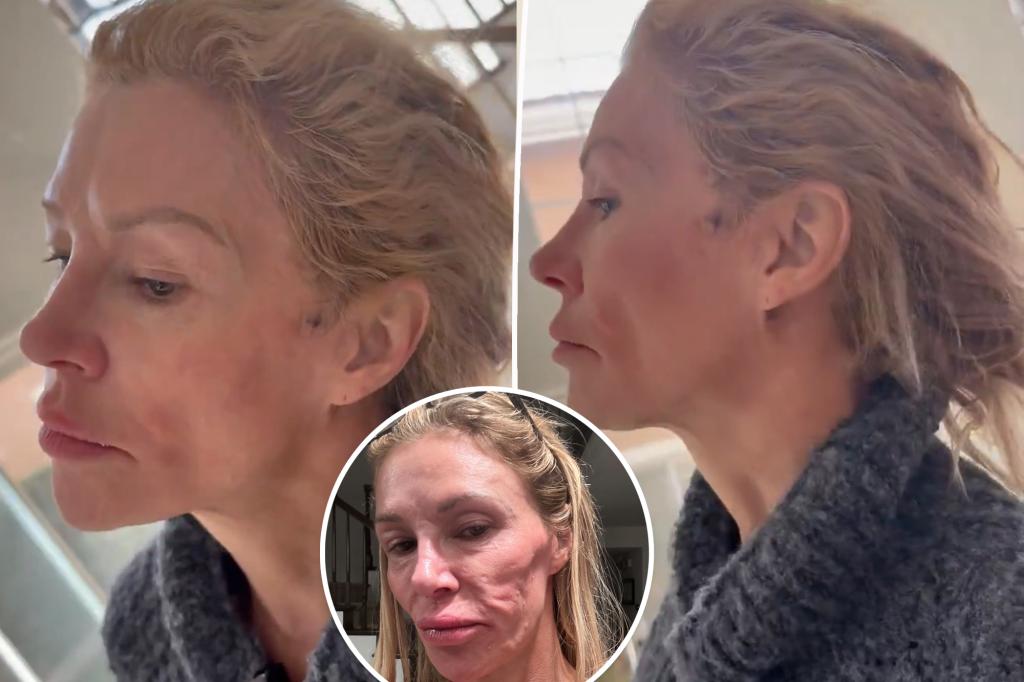 Brandi Glanville shakes quickly whereas present process remedy for facial parasite